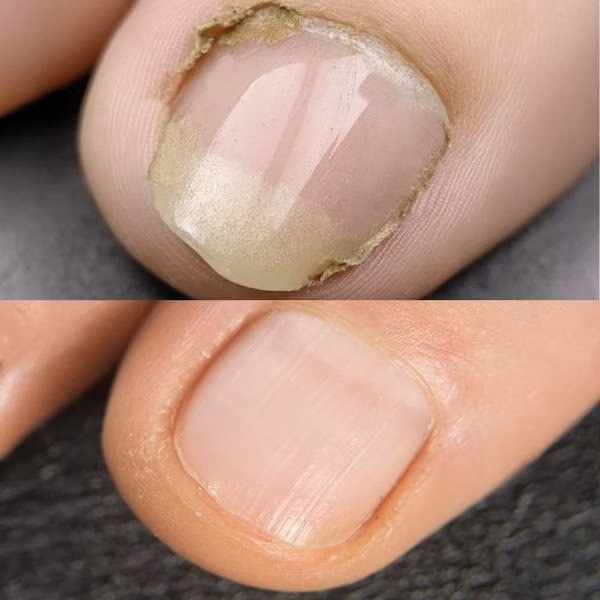 IZA Effect Anti Fuss- & Nagelpilz Spray 1+1 Gratis