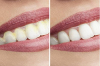 DentaPic Sonic shiny white teeth 1+1 free