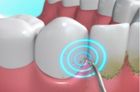 DentaPic Sonic shiny white teeth 1+1 free