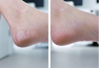 Pedi Vac Hornhautentferner 1+1