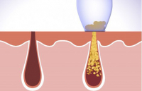 Derma Suction für strahlende Haut + Tasche gratis