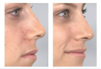 Derma Suction für strahlende Haut + Tasche gratis